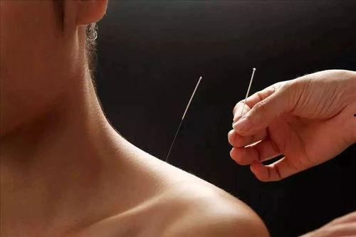 成人高烧怎么针灸治疗视频,视频详解